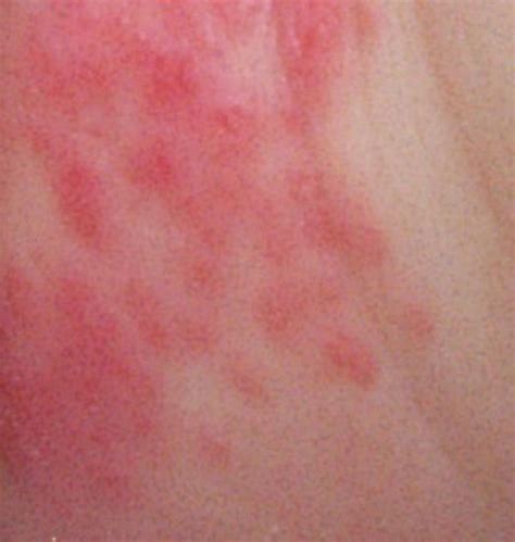 DIAPER RASh