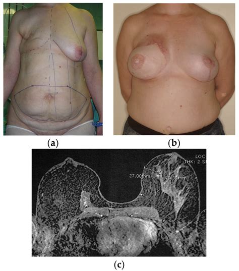 DIEP Flap - breast cancer