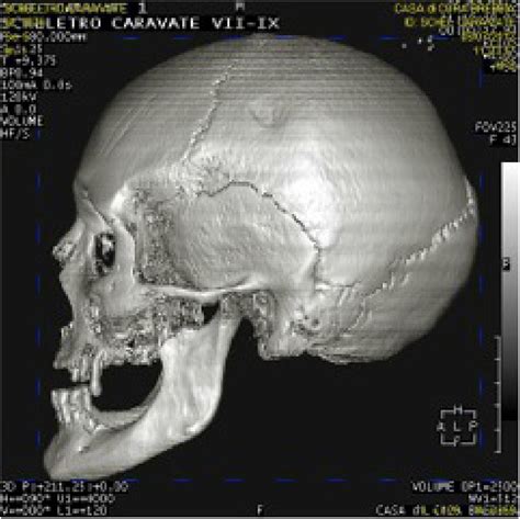 Different types of traumatic lesions on mediaeval skeletons from ... - wintechmobiles.com