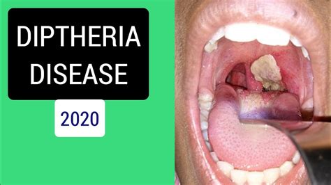 diphtheria adalah - elchoricharrua.com