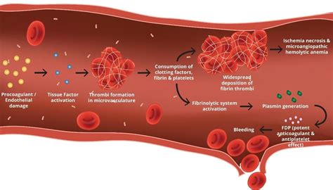 DISSEMINATED INTRAVASCULAR COAGULATION IN …