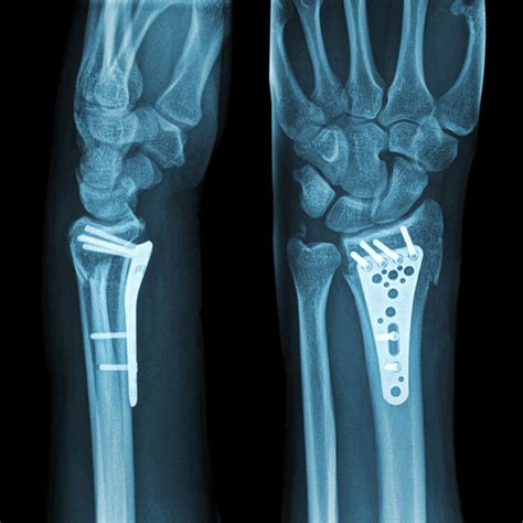 Distal Radius Fracture Plate - wintechmobiles.com