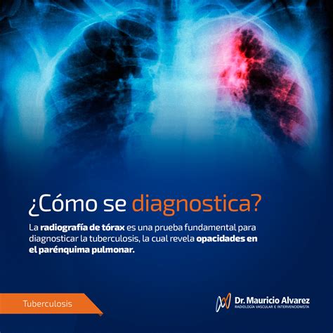 dr tuberculosis - elchoricharrua.com