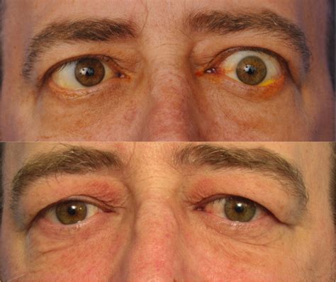 Damaged Eye Socket Reconstruction Surgery Los Angeles - Orbital …