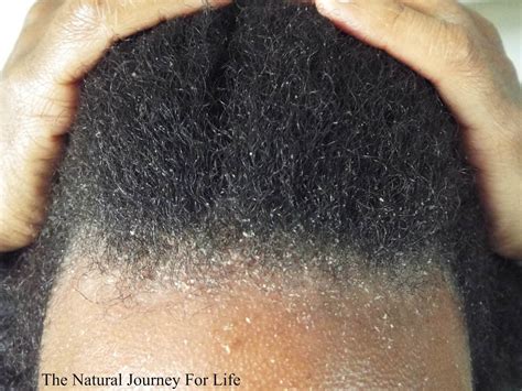 Dandruff - Black Hair Information