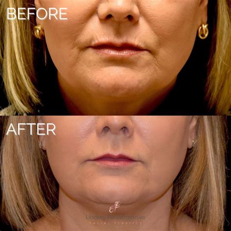 Dao botox before and after. Apr 12, 2021 · Botox treatments generally last three to four months. The length of time and progress depends upon the severity of your wrinkles and the amount of the Botox that you receive. As the injections wear off, muscle action will gradually resume. This will cause fine lines and wrinkles to reappear. After repeated treatments, the lines and wrinkles ... 