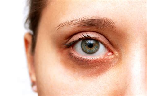 Dark Circles Under Eyes: Causes & Treatment Paula