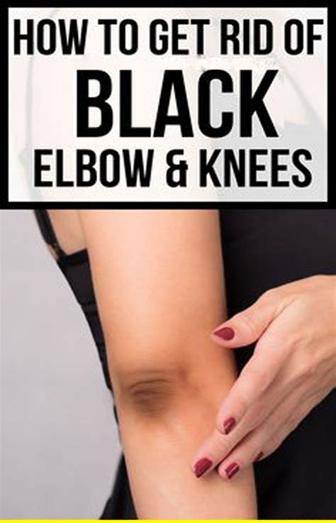 Dark Elbows: Causes, Home Remedies, and More