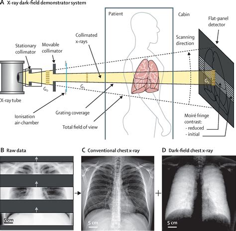 Dark-field chest X-ray imaging for the assessment of COVID-19-pneum…