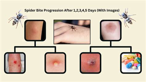 Day 1 Spider Bite Identification Chart