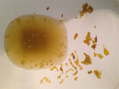 Acute white mucus in poop is often due to an attack of gastroenteritis or dehydration. Chronic or recurrent white mucus in poop can be due to irritable bowel syndrome, anorectal fissures, inflammatory bowel diseases, etc. Common causes include: Occasional findings in healthy people. Acute infections (gastroenteritis).. 