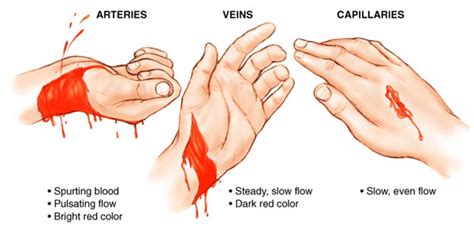 Deadly Bleeding & How to Stop it: - LinkedIn