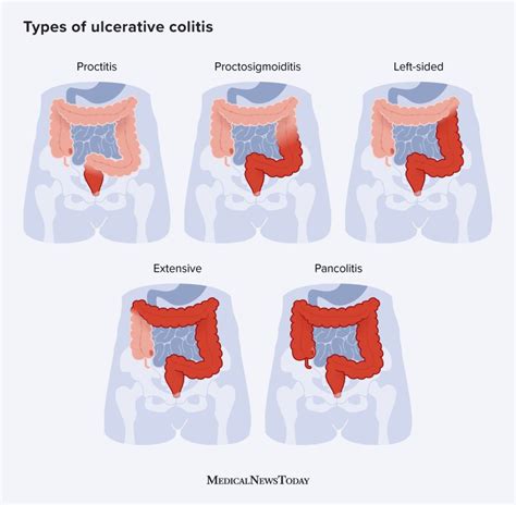 Dealing with different Types of Colitis Everyday Health