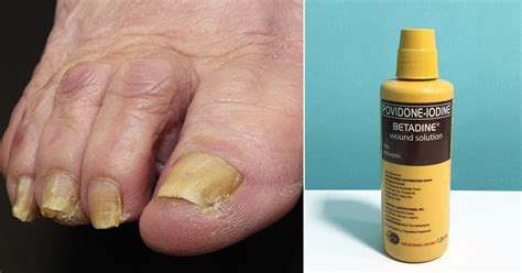 Damaged nails are most susceptible, and people who have immune sys
