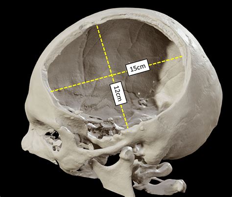 Decompressive craniectomy for traumatic brain injury