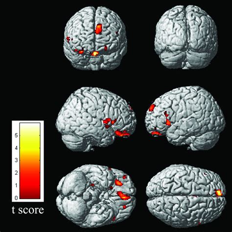 Decreased gray matter volume of the anterior insular cortex in …