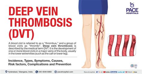 Deep Vein Thrombosis (DVT) - Causes, Symptoms & Treatment