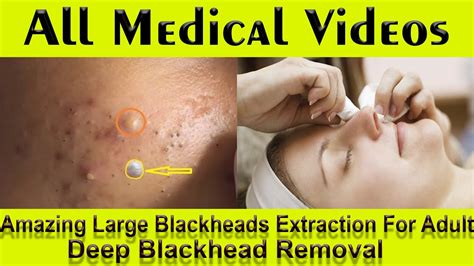 Deep blackhead removal videos. Things To Know About Deep blackhead removal videos. 