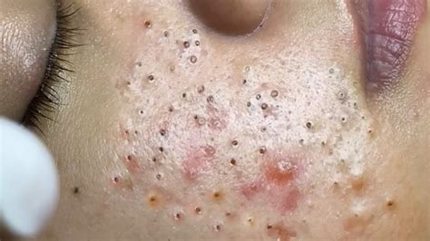 Blackheads on Nose and Forehead. Pimple popping videosMUSIC:Kevin MacLeod (incompetech.com)Licensed under Creative Commons: By Attribution 3.0 Licensehttp://.... 