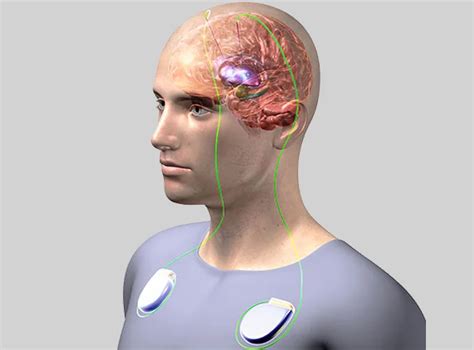 Deep brain stimulation centres uk.  Access premium healthcare with full coverage...