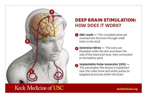 Deep brain stimulation cost medicare.  Evidence-based guide to non-invasive brain...