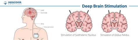 Deep brain stimulation eligibility. .  <a href=https://mkgem.ru/jhq0dsk/noodlehe...