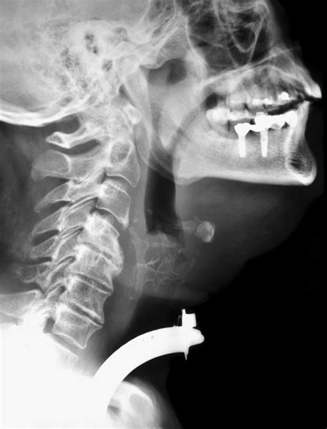 Deep throat x-ray. Things To Know About Deep throat x-ray. 