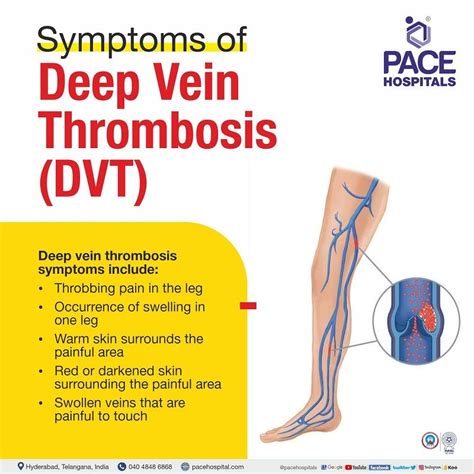 Deep vein thrombosis history and symptoms - wikidoc