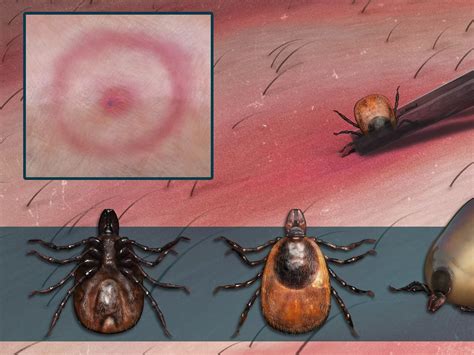 Deer Tick Bite: How to Treat and Identify What Ticks Look …