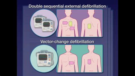 Defibrillation’s Alternative « Kurzweil