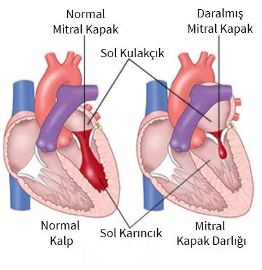 Dejeneratif aort ve mitral kapak