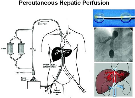 Delcath. Delcath's Hepzato Kit is a drug/device combo that administers the decades-old chemotherapy melphalan into the liver through a process called percutaneous hepatic perfusion, according to the company. 
