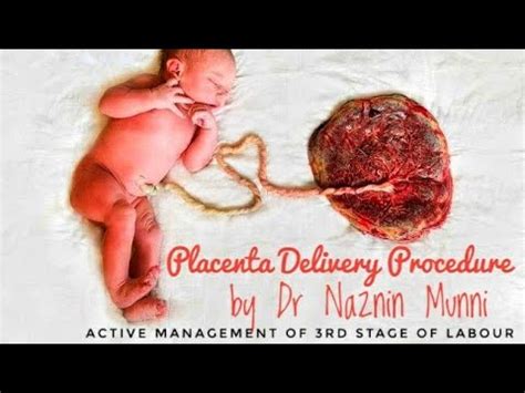 Delivering the placenta in the third stage of labour