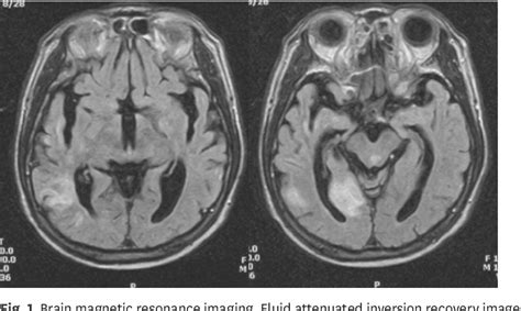 Delusional parasitosis in patients on dialysis.