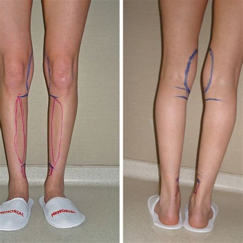 Answer: Leg dent. The contour dent you show in your photo is that you have some fat accumulation above and below this area, and it can be corrected with some mild liposuction. Helpful. Malcolm A. Lesavoy, MD, FACS. July 26, 2016.. 