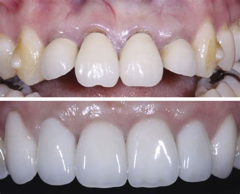 Dental Crown Before & After Pictures - RealSelf