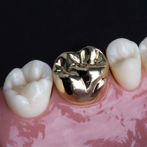 Dental Crowns Birmingham - Porcelain, Ceramic, Metal …