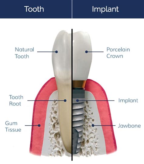 Dental Implant Centre Southside Dental Implants Sydney