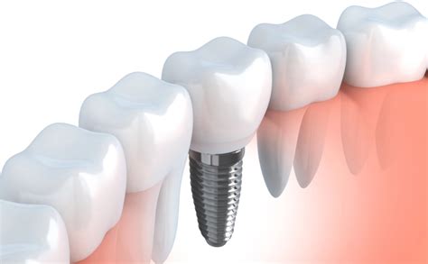 Dental Implants Pensacola FL Spanish Trail Dentistry