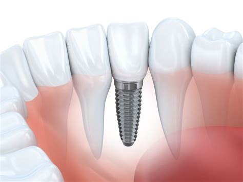 Dental Implants Williamstown - wyndhamdental