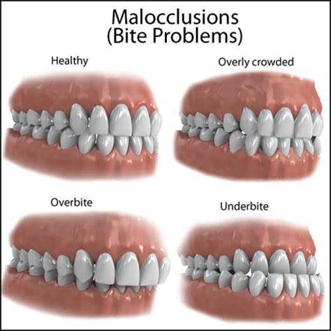 Dental Malocclusion: Fix Crooked Teeth, Even …