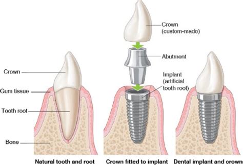 Dental Mini-Implants - StatPearls - NCBI Bookshelf