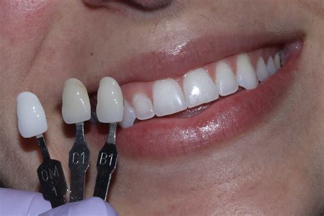 Dental Veneers: Why and How They