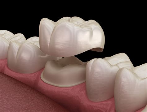 Veneers and crowns are similar in appearance, but there are some differences in function. Learn more about the differences between veneers and crowns. Menu. Health A-Z COVID-19; ... Crowns can also serve the purpose of holding a dental bridge in place, covering a dental implant, or covering misshapen or badly discolored teeth. Procedure .. 