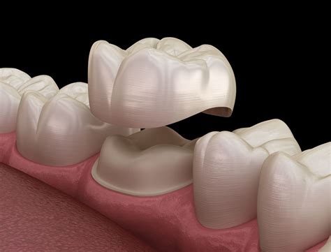 Rosemary Terpolilli Updated August 31, 2023 Reviewed by Charles Potters Are crowns covered by dental insurance? The short answer is yes, but not in all cases. The most important determinant...