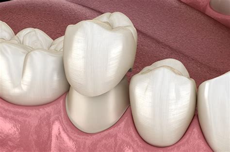 Dental insurance that covers crowns immediately. Things To Know About Dental insurance that covers crowns immediately. 