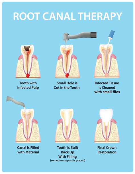 Many dental plans cover the full cost of biannual dentist visits and routine cleanings. More expensive procedures, such as fillings, root canals and crowns, are usually partially covered with .... 