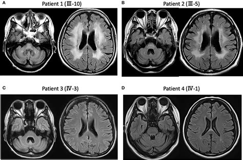 Dentatorubral-Pallidoluysian Atrophy - an overview