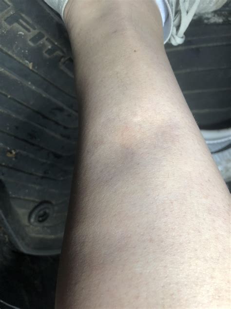 Dented leg. Sep 3, 2019 · swelling in only one leg: deep venous thrombosis (DVT), caused by a blood clot in a vein, or cellulitis. sudden onset of painful swelling in your calf: DVT. little urine production: kidney disease ... 