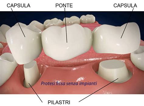 Denti fissi senza impianto - Dentista Resta